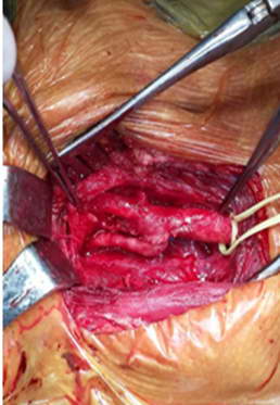 Առաջին անգամ Հայաստանում իրականացվել է բարդ վիրահատություն. պարանոցի ուռուցքի հեռացում եւ գլխուղեղը սնող անոթների պաթոլոգիայի միափուլ շտկում