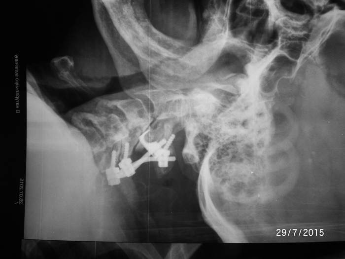 Single-step treatment of the cervical spinal stenosis