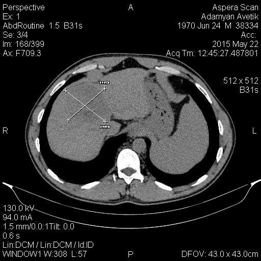 Another case of chemoembolization of the liver injured by the tumor is carried out