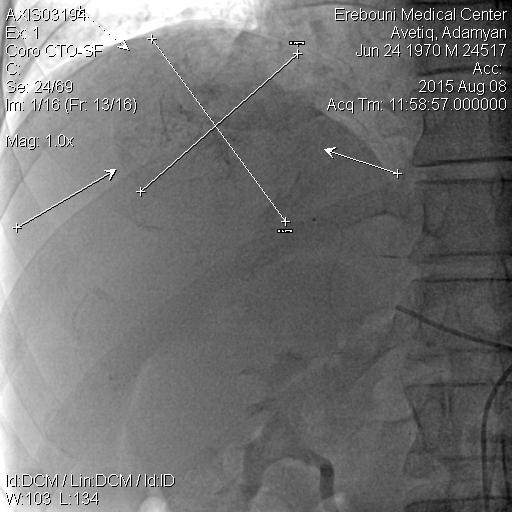 Another case of chemoembolization of the liver injured by the tumor is carried out