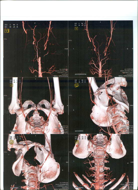 Simultaneous operation for the treatment of the carotid arteries stenosis and the blockage of the aorta