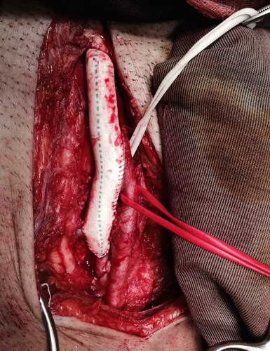 Simultaneous operation for the treatment of the carotid arteries stenosis and the blockage of the aorta