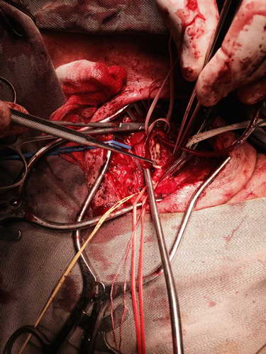 Simultaneous operation for the treatment of the carotid arteries stenosis and the blockage of the aorta