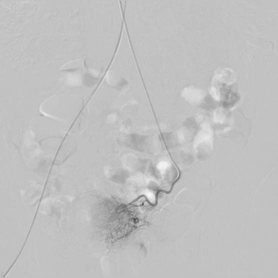 Uterine artery embolization - optimal decision for the treatment of myomas