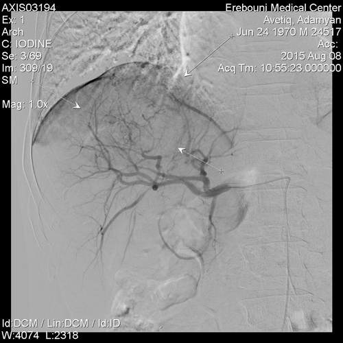 Субтракционная контрастная ангиография печеночной артерии (стрелками указана  4-ый сегмент печени, где визуализируется хорошо васкуляризированная  опухоль)