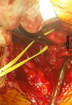 Патологическая деформация левой позвоночной артерии (указана стрелкой).