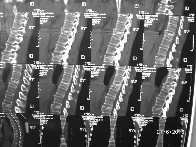 Spine fracture treatment with minimally invasive technique