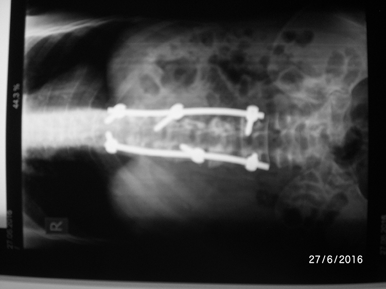 Spine fracture treatment with minimally invasive technique
