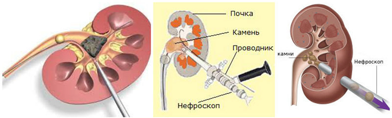 Конкремент латынь