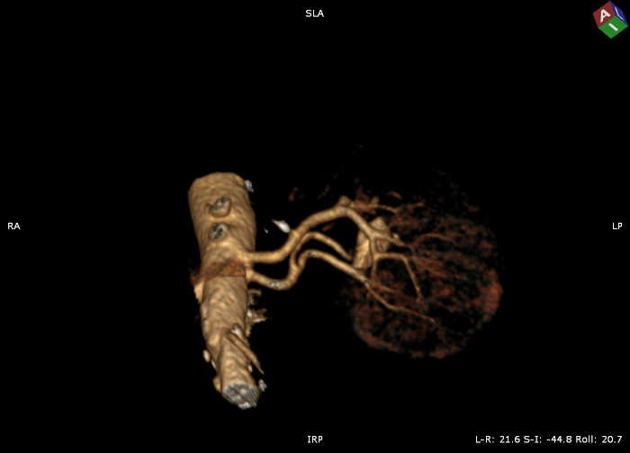 3D reconstruction of renal arteries before embolization