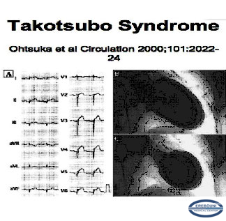 ECG and ventriculography in Takotsubo cardiomiopathy