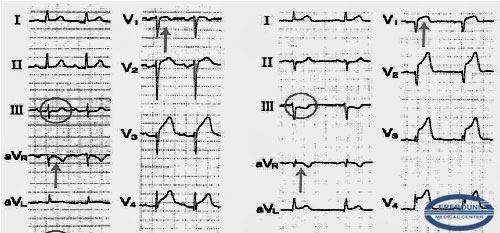 ECG differential diagnostics between Takotsubo cardiomyopathy and acute myocardial infarction of anterior localization.