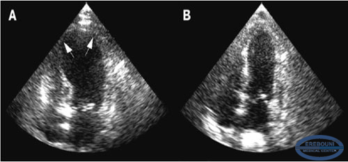 Two-dimensional echocardiography - image Takotsubo cardiomyopathy.