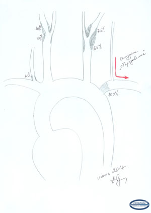 A schematic of brachiocephalic artery lesion