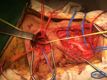 Surgical field at the beginning of intervention. Involved vessels are separated and taken on the holders.