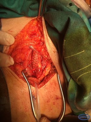 Femoral (inferior)ends of aorto-femoral prosthesis.