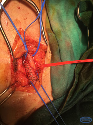 Femoral (inferior)ends of aorto-femoral prosthesis.