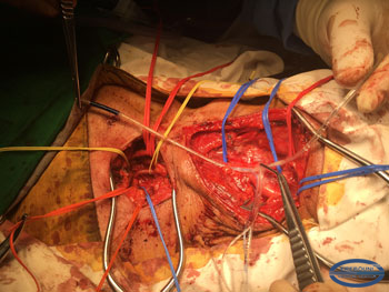  Внутренний шунт до установки в артерию, показан в проекции артерии – проксимальный баллон будет расположен ниже анастомоза