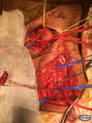 Сонная артерия рассечена, внутренний шунт установлен, поле подготовлено к сонно-подключичному шунтированию