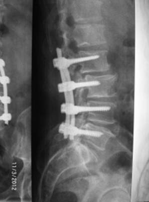 Spinal stenosis and instability of the vertebrae of the lumbar spine