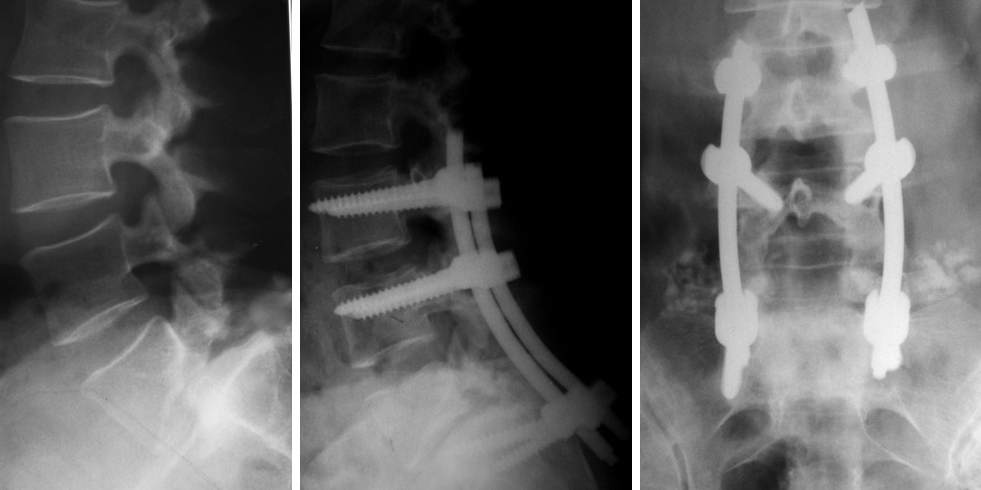 Spondylolysis/spondylolisthesis of the lumbar vertebrae