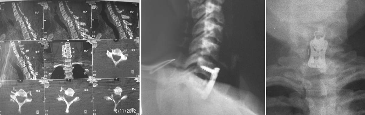  Cervical spine fracture with dislocation. Fixation with plates and Cage.