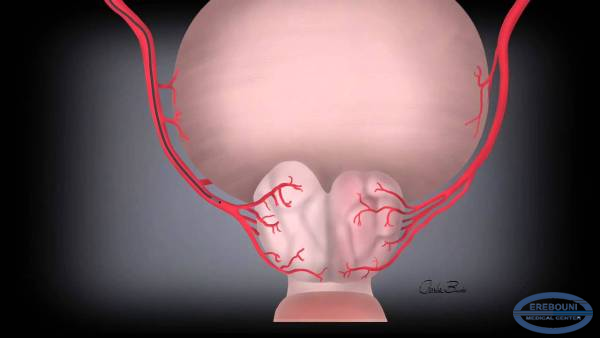 Tumors can be removed without open surgery. Embolization.