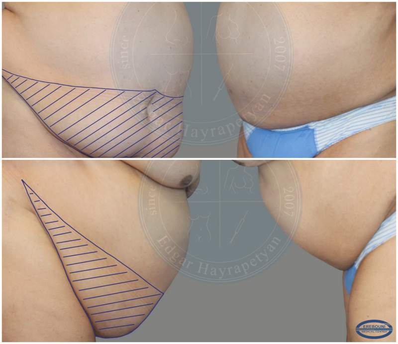 Abdominoplasty