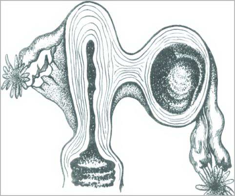 Uterine malformations:  Vestigial womb