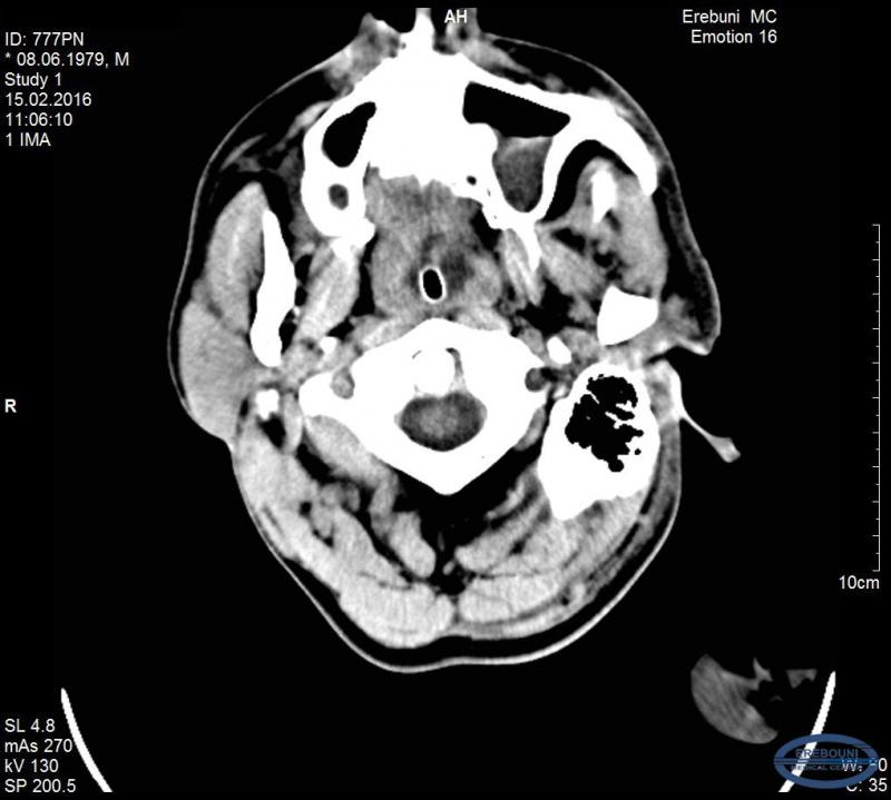 Subdural empyema. Surgical treatment