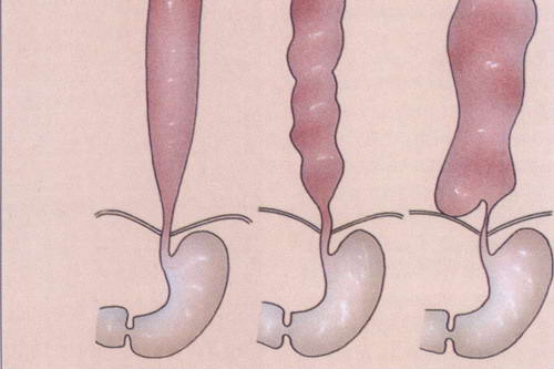 Esophageal achalasia