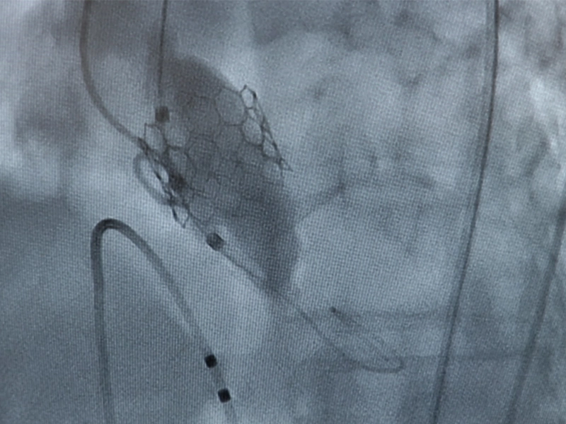 Transcatheter endovascular aortic valve replacement